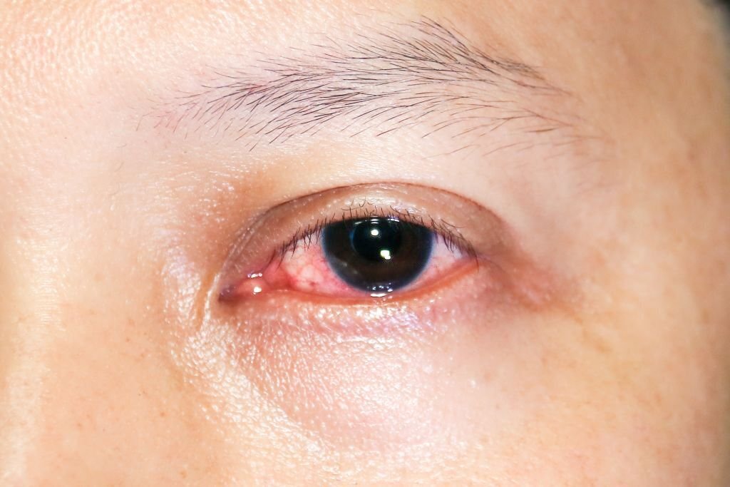 Image Of Eye Has Infection And Conjunctivitis