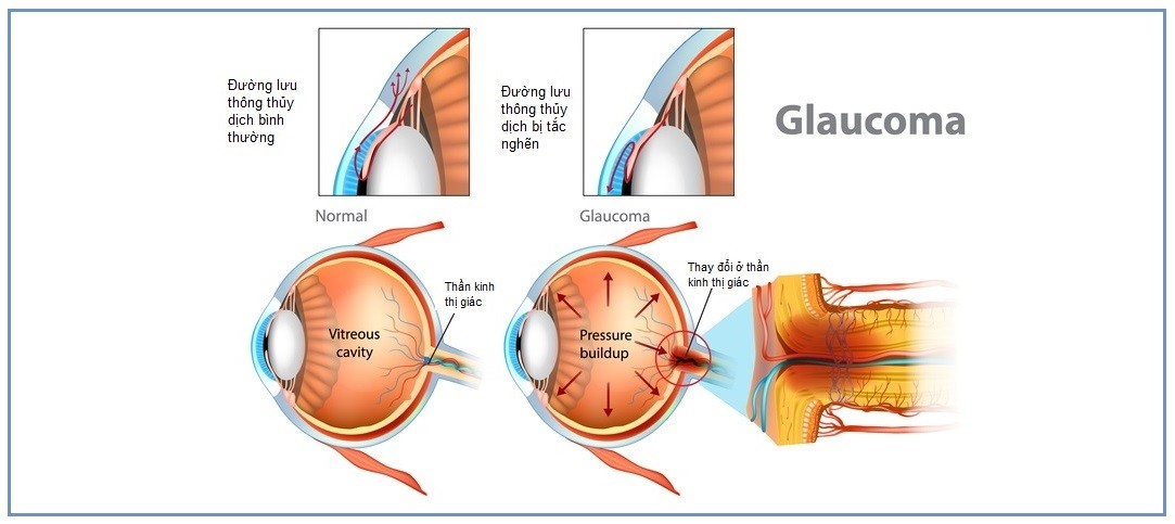 Áp lực nội nhãn tăng dẫn tới bệnh thiên đầu thống