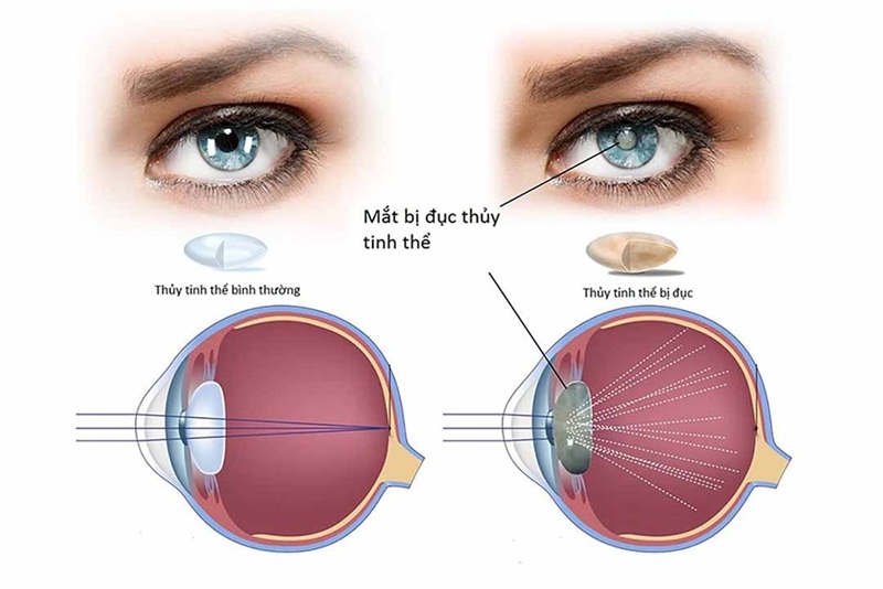 Dấu hiệu nhận biết bệnh đục thủy tinh thể
