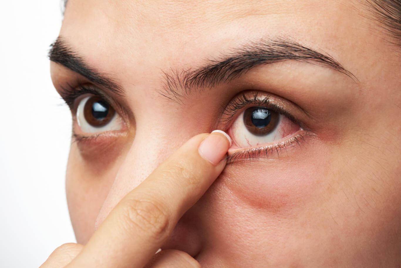 Đái tháo đường gây ra bệnh võng mạc đái tháo đường