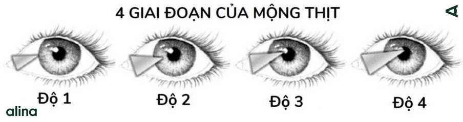 Các giai đoạn của bệnh mộng thịt