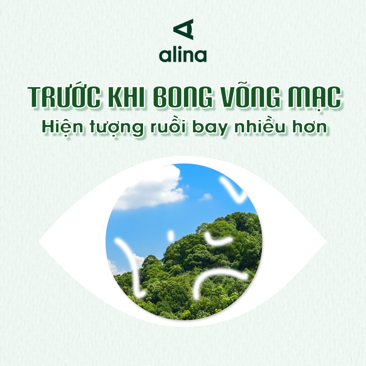 Khi võng mạc thoái hóa hoặc rách (trước khi bong võng mạc xảy ra)