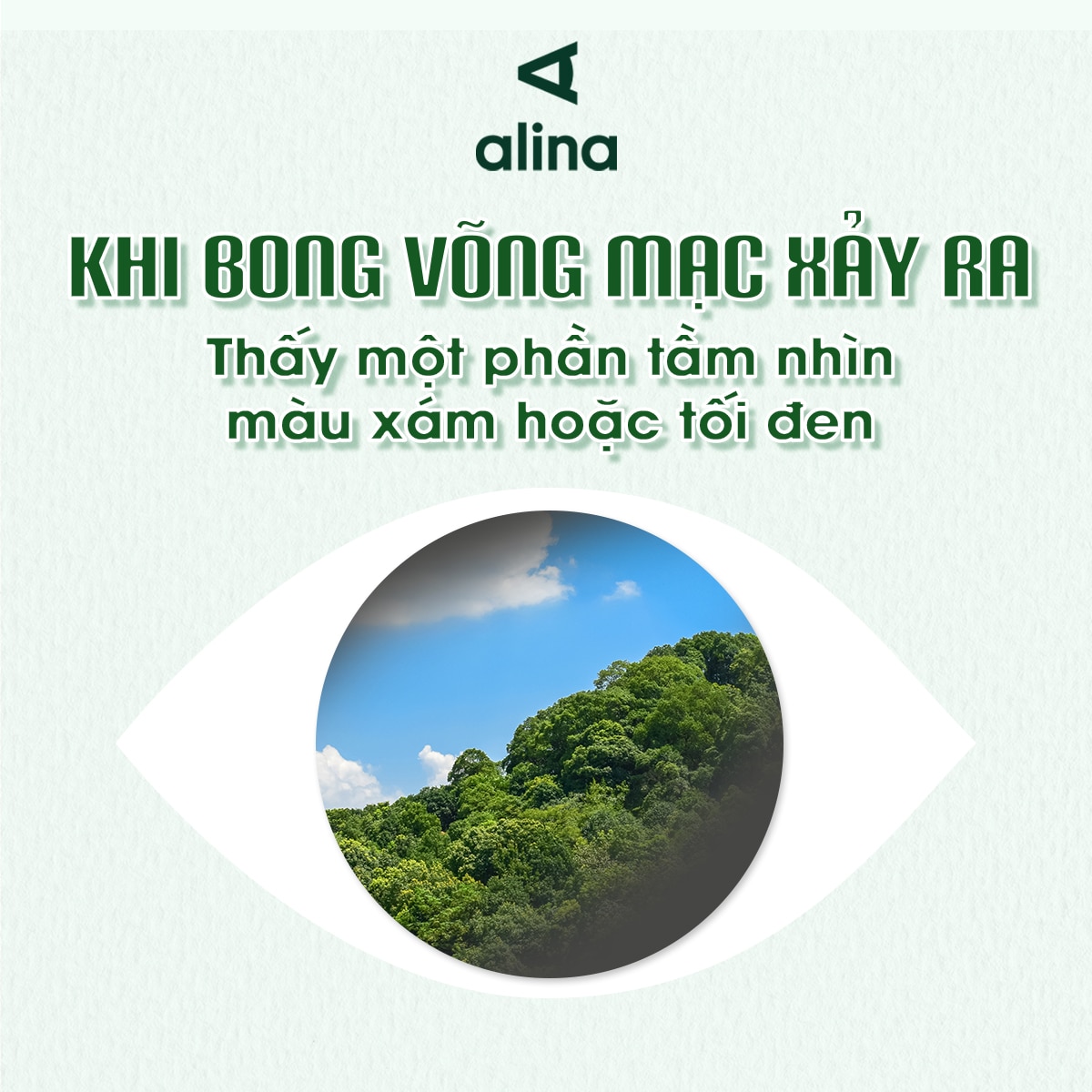 Khi bong võng mạc đã xảy ra