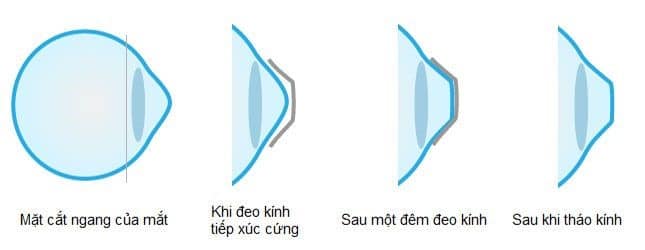 Nguyên lý hoạt động của kính Ortho K